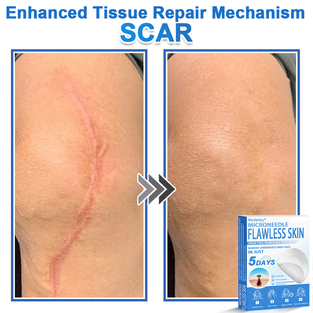 🔥Last Day 80% OFF 👨‍⚕️  Neslemy® 2-in-1 Microneedle & Hydrocolloid Patch | Raised Moles,Acne,  Flat Warts & Skin Tags Remover | Improves Wrinkles, Scars & Blemishes | Invisible Pimple Patches for Face & Body