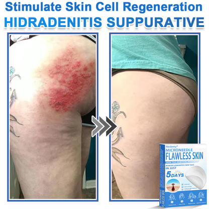 🔥Last Day 80% OFF 👨‍⚕️  Neslemy® 2-in-1 Microneedle & Hydrocolloid Patch | Raised Moles,Acne,  Flat Warts & Skin Tags Remover | Improves Wrinkles, Scars & Blemishes | Invisible Pimple Patches for Face & Body