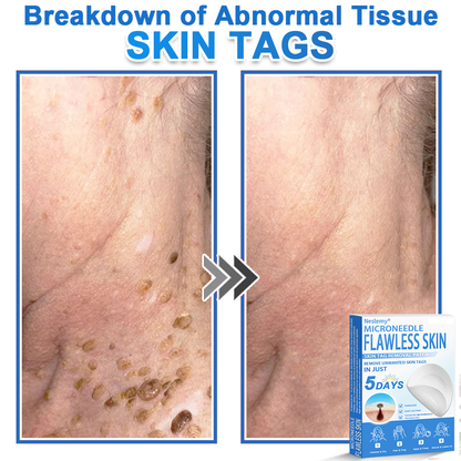 🔥Last Day 80% OFF 👨‍⚕️  Neslemy® 2-in-1 Microneedle & Hydrocolloid Patch | Raised Moles,Acne,  Flat Warts & Skin Tags Remover | Improves Wrinkles, Scars & Blemishes | Invisible Pimple Patches for Face & Body