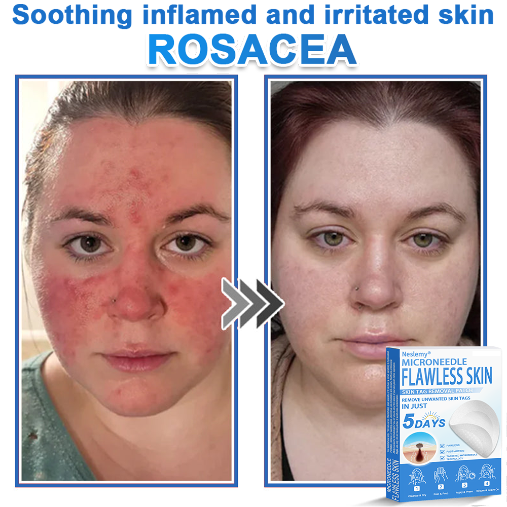 🔥Last Day 80% OFF 👨‍⚕️  Neslemy® 2-in-1 Microneedle & Hydrocolloid Patch | Raised Moles,Acne,  Flat Warts & Skin Tags Remover | Improves Wrinkles, Scars & Blemishes | Invisible Pimple Patches for Face & Body