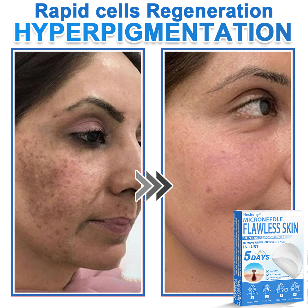 🔥Last Day 80% OFF 👨‍⚕️  Neslemy® 2-in-1 Microneedle & Hydrocolloid Patch | Raised Moles,Acne,  Flat Warts & Skin Tags Remover | Improves Wrinkles, Scars & Blemishes | Invisible Pimple Patches for Face & Body