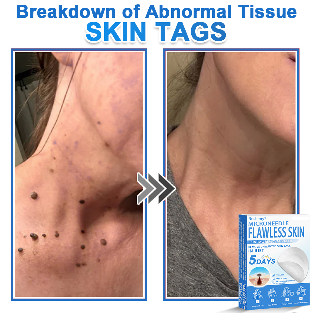 🔥Last Day 80% OFF 👨‍⚕️  Neslemy® 2-in-1 Microneedle & Hydrocolloid Patch | Raised Moles,Acne,  Flat Warts & Skin Tags Remover | Improves Wrinkles, Scars & Blemishes | Invisible Pimple Patches for Face & Body
