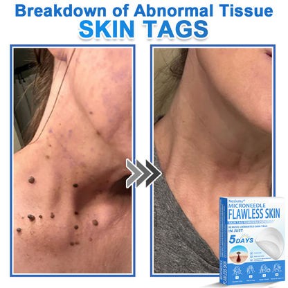 🔥Last Day 80% OFF 👨‍⚕️  Neslemy® 2-in-1 Microneedle & Hydrocolloid Patch | Raised Moles,Acne,  Flat Warts & Skin Tags Remover | Improves Wrinkles, Scars & Blemishes | Invisible Pimple Patches for Face & Body