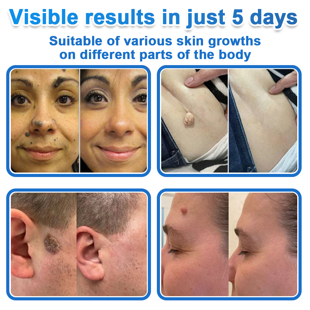🔥Last Day 80% OFF 👨‍⚕️  Neslemy® 2-in-1 Microneedle & Hydrocolloid Patch | Raised Moles,Acne,  Flat Warts & Skin Tags Remover | Improves Wrinkles, Scars & Blemishes | Invisible Pimple Patches for Face & Body