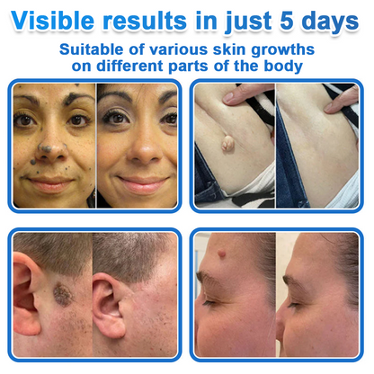 🔥Last Day 80% OFF 👨‍⚕️  Neslemy® 2-in-1 Microneedle & Hydrocolloid Patch | Raised Moles,Acne,  Flat Warts & Skin Tags Remover | Improves Wrinkles, Scars & Blemishes | Invisible Pimple Patches for Face & Body
