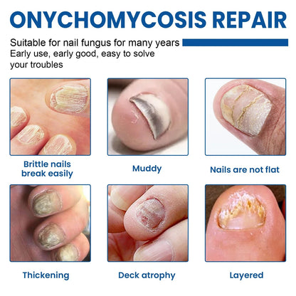 🔥 Last Day 50% OFF NESLEMY® Nail Fungus Care Patches 🩹 From Yellow, Brittle-Looking Nails to Clearer, Healthier-Looking Nails