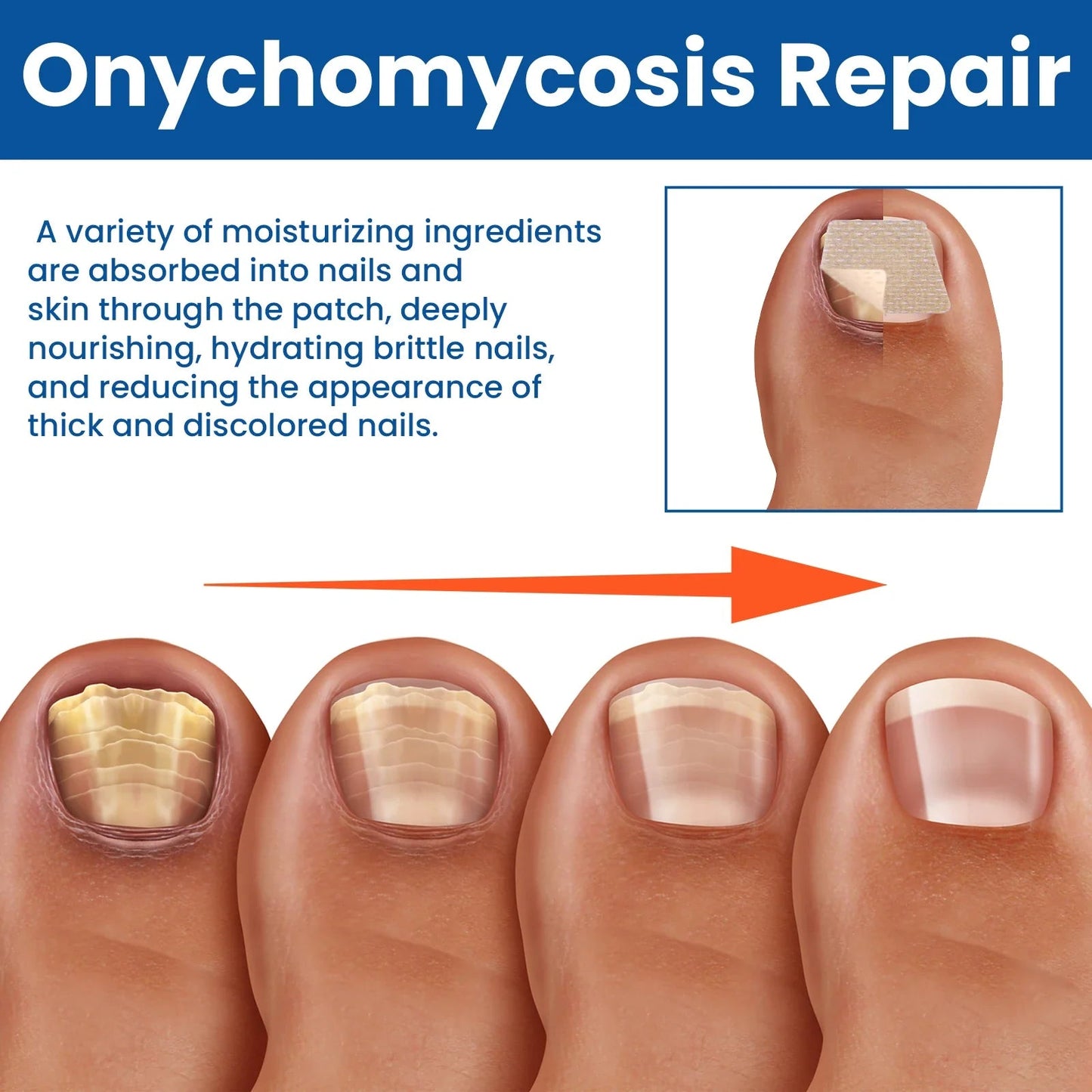 🔥 Last Day 50% OFF NESLEMY® Nail Fungus Care Patches 🩹 From Yellow, Brittle-Looking Nails to Clearer, Healthier-Looking Nails