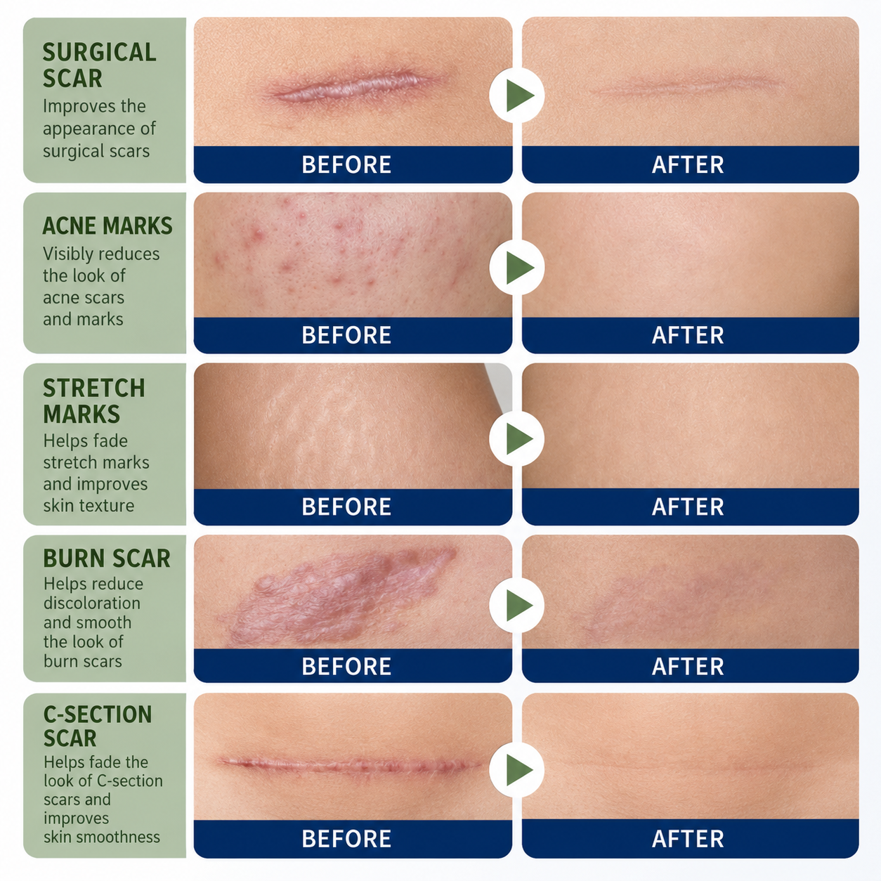 SILICONE SCAR GEL Flatten. Soften. Fade. - PharmacistRecommended Scar Therapy