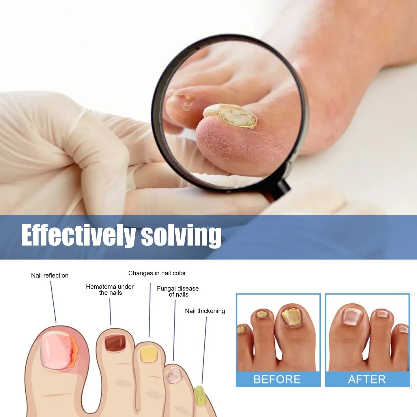🔥 Last Day 50% OFF NESLEMY® Nail Fungus Care Patches 🩹 From Yellow, Brittle-Looking Nails to Clearer, Healthier-Looking Nails